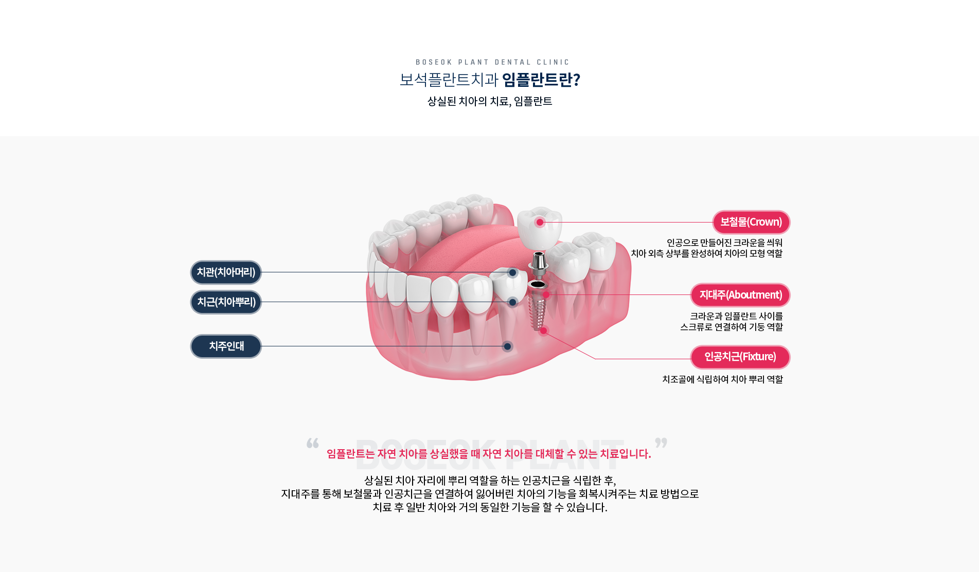 임플란트란?