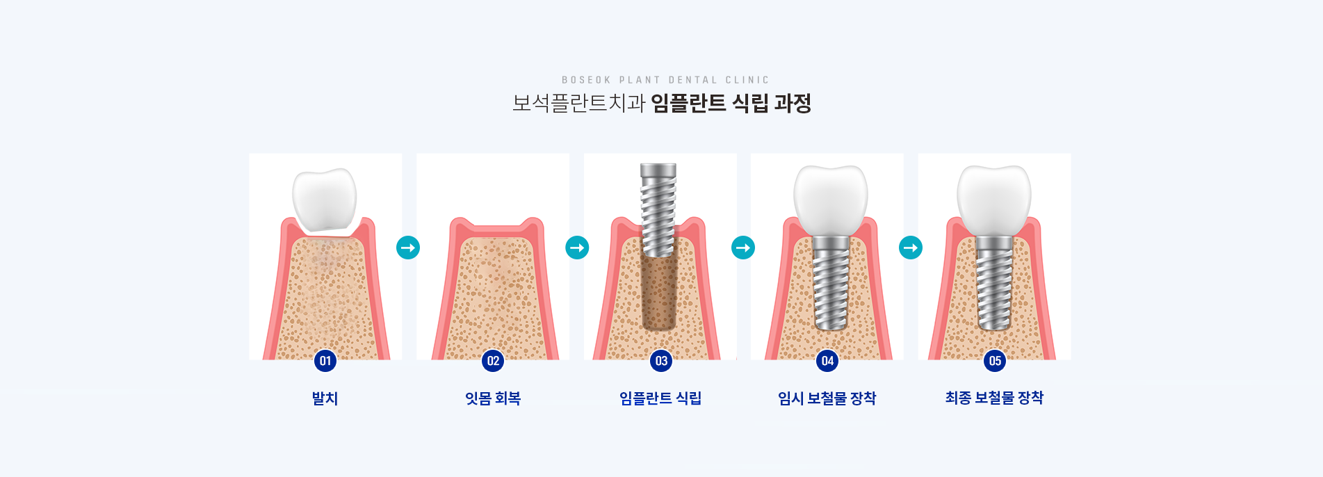 임플란트 식립 과정