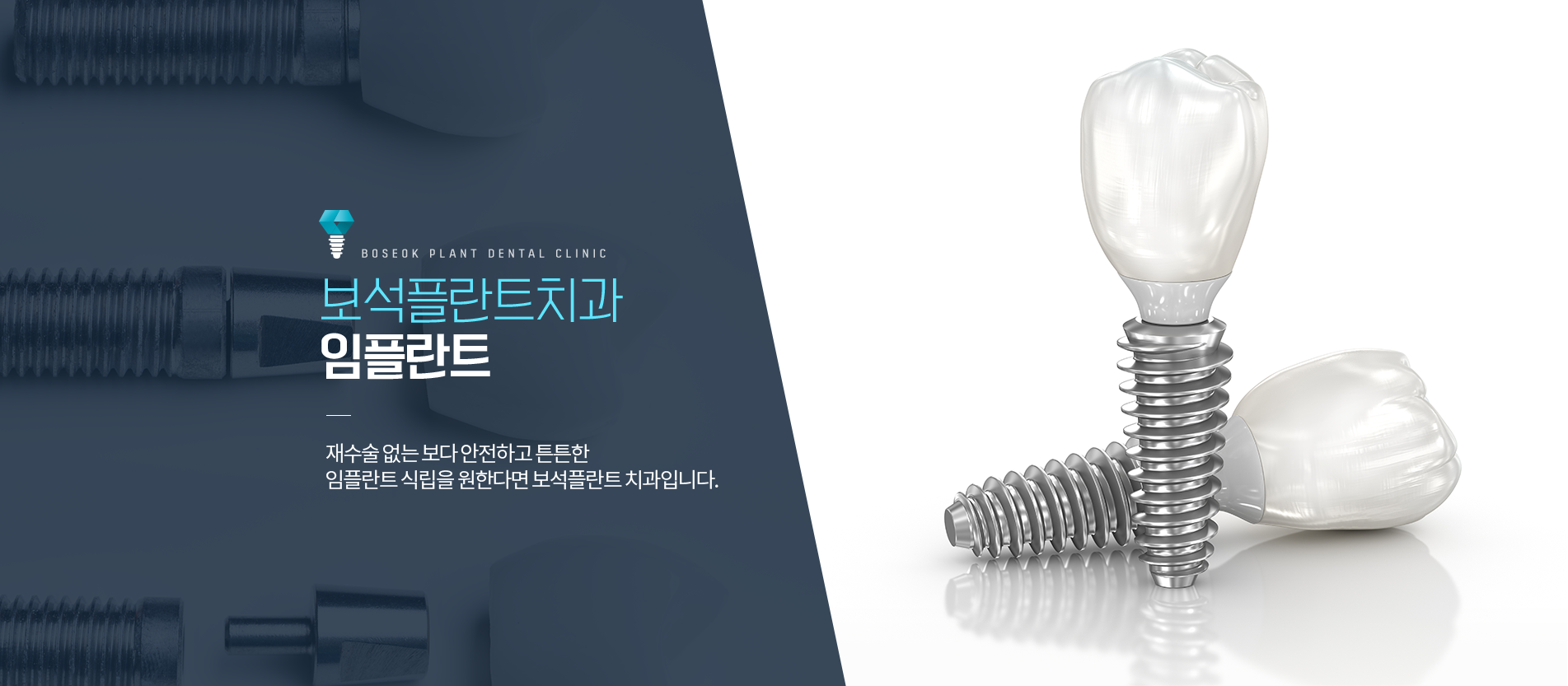보석플란트 임플란트