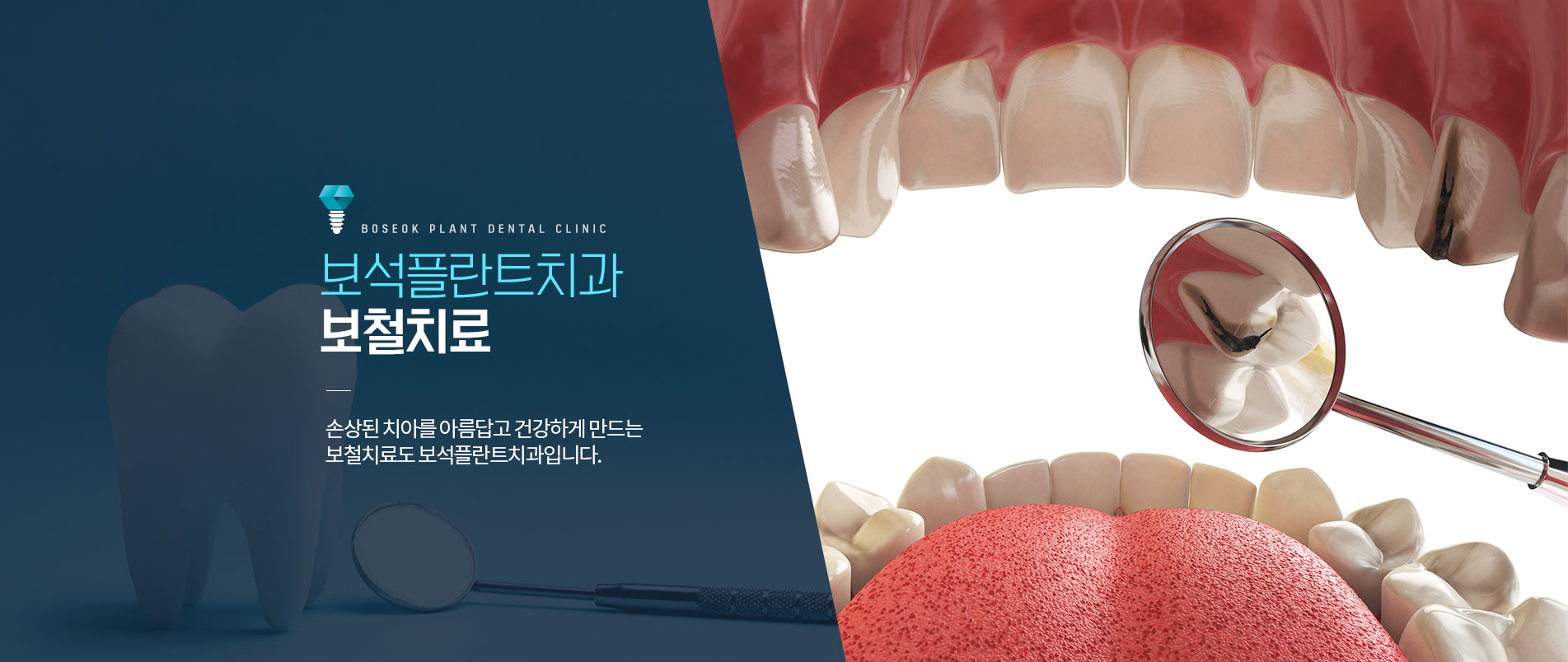 보석플란트 보철치료