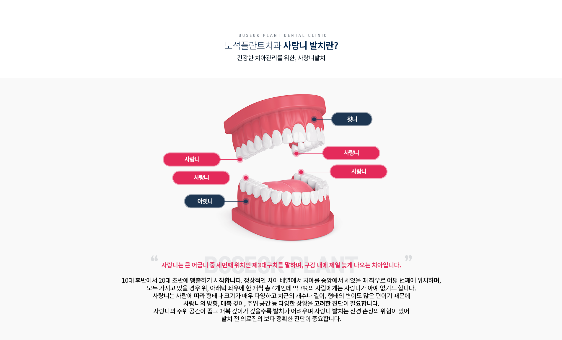 사랑니발치란?