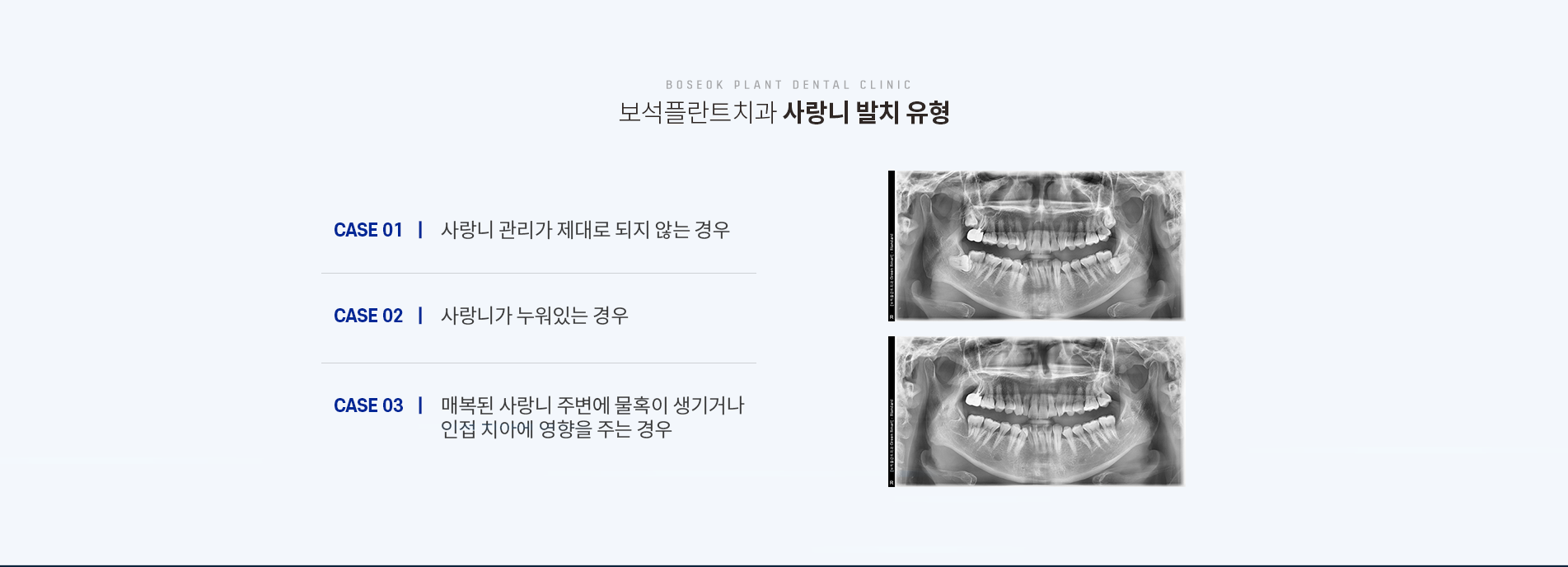 사랑니발치 유형
