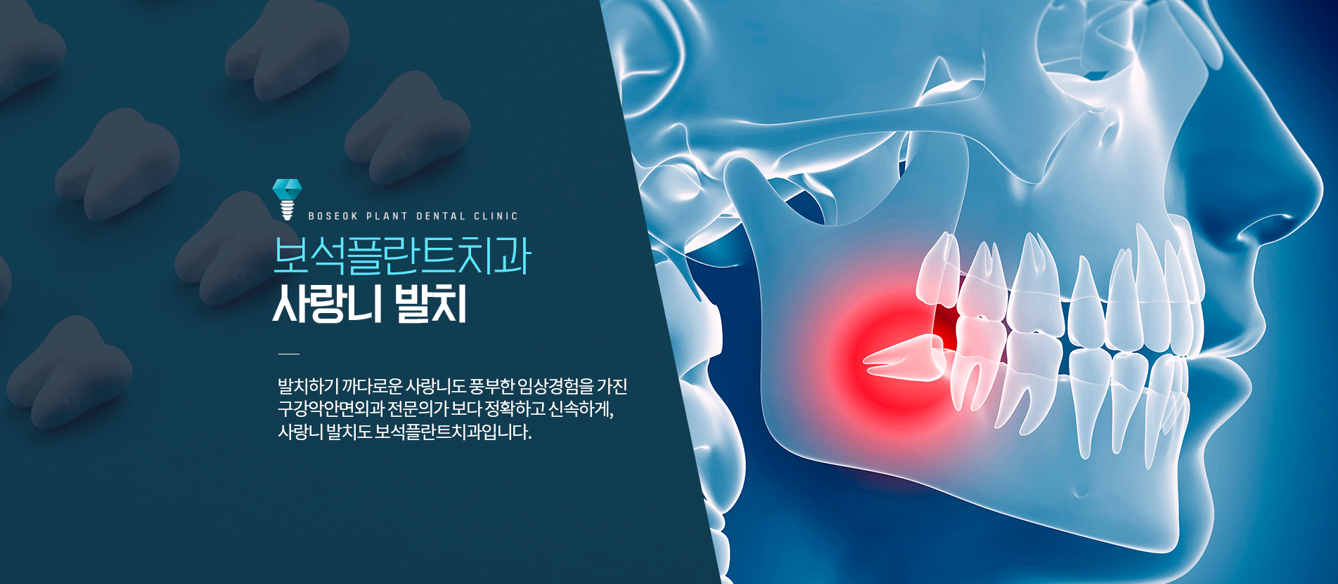 보석플란트 사랑니발치